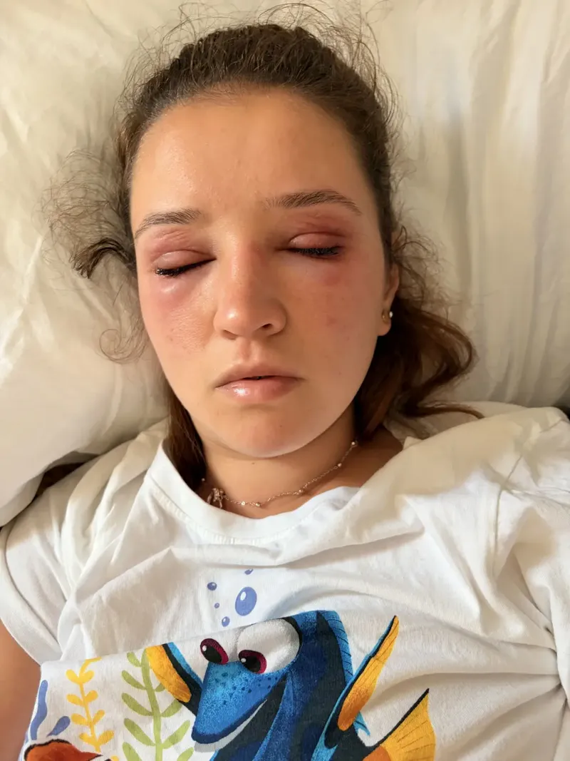 Reaksi Alergi Eyelash Extension dan Cara Mencegah Mata Bengkak