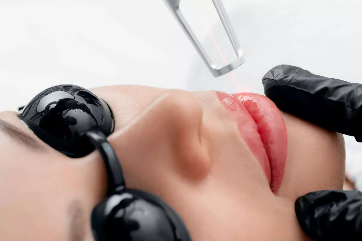 Efek Samping Laser Bibir yang Jarang Diungkap