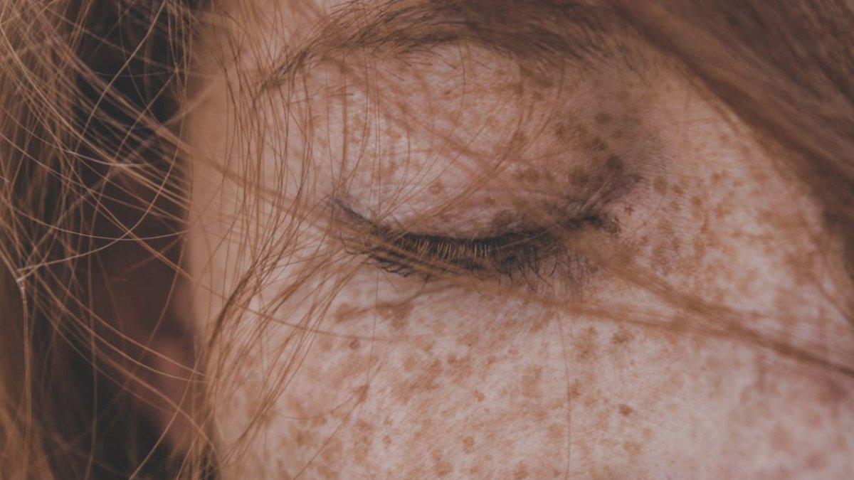 Mengapa Flek Hitam Tak Selalu Hilang dengan Laser
