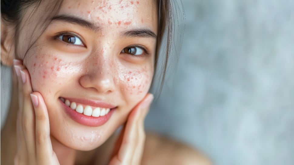 5 Acne Spot Treatment Korea yang Mengeringkan Jerawat Cepat