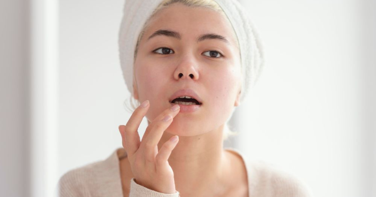 3 Bahan Alami Ampuh Atasi Bibir Kering Pecah-Pecah