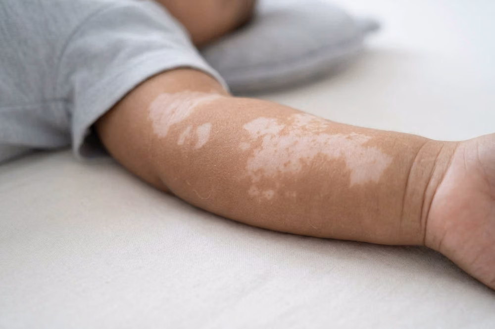 Bercak dan Kemerahan pada Kulit Bayi: Cara Mengenali dan Merawatnya