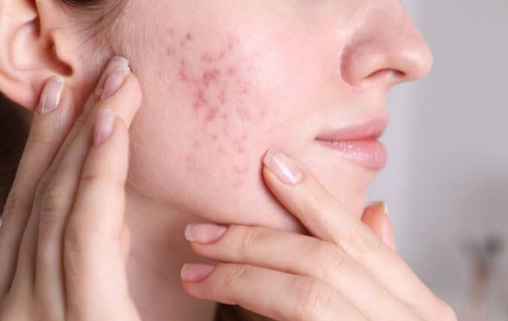 5 Sunscreen Non-Comedogenic Terbaik untuk Kulit Berjerawat