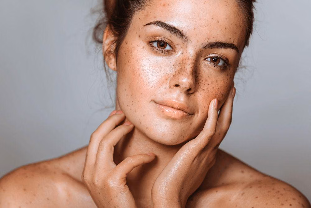 Freckles vs Sunspots vs Dark Spots: Cara Membedakan Flek dan Risikonya