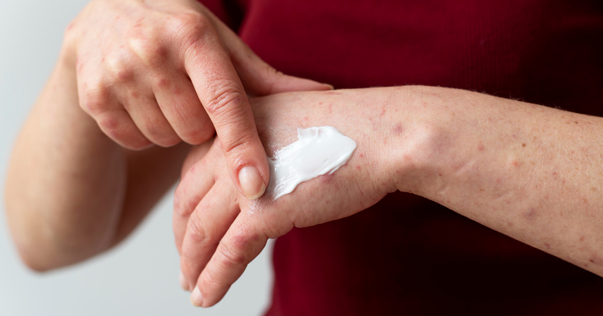 4 Kandungan Skincare yang Wajib Dihindari Penderita Eksim
