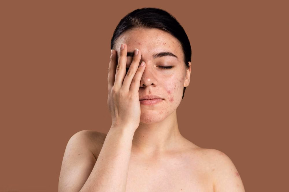 Rutinitas Skincare Lengkap untuk Kulit Berminyak Berjerawat