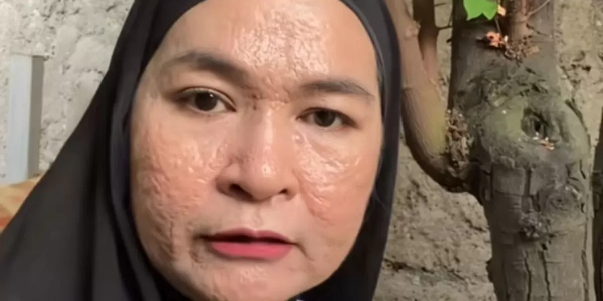 7 Kesalahan Skincare Remaja yang Memperburuk Jerawat