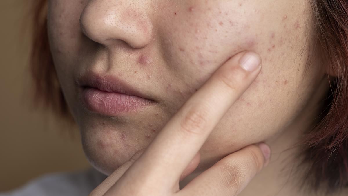 Azelaic Acid untuk Bekas Jerawat Merah dan Hitam