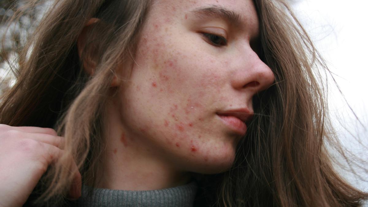 Panduan Lengkap Memilih Acne Pad Sesuai Jenis Jerawat dan Kondisi Kulit