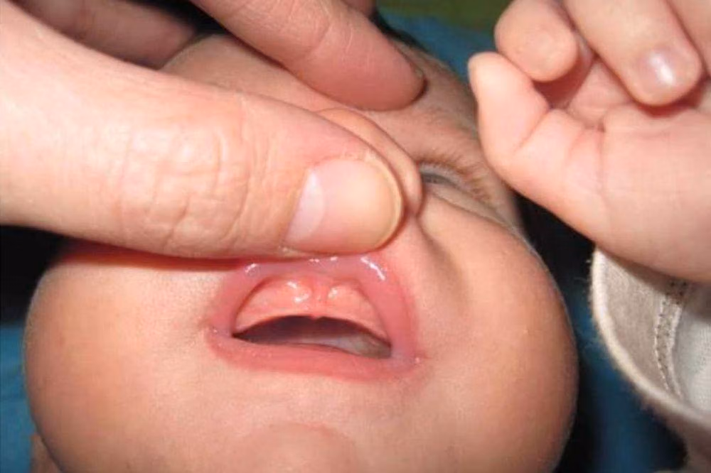 Lip Tie pada Bayi: Mengenali dan Menentukan Langkah