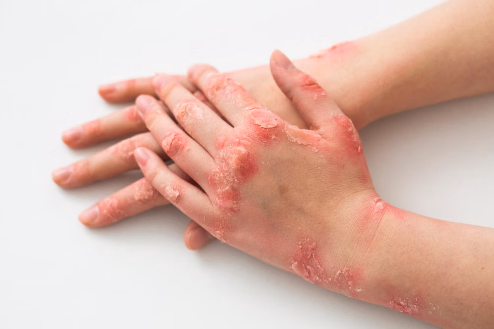 Gejala Awal Autoimun Kulit yang Sering Dikira Dermatitis
