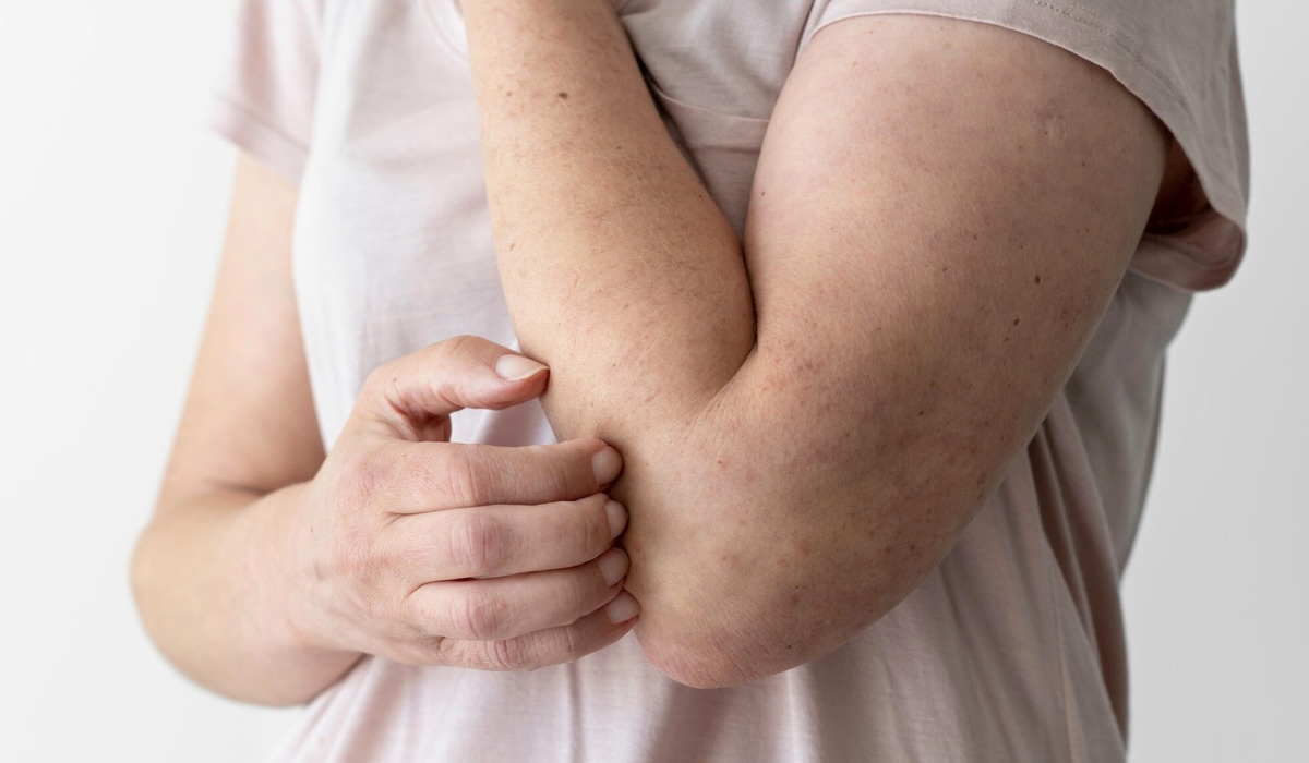Memutus Siklus Gatal Eksim dengan Menguatkan Skin Barrier