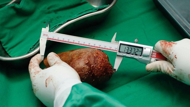 Lima Fungsi Ginjal yang Jarang Diketahui dan Bahaya Dehidrasi Sehari-hari