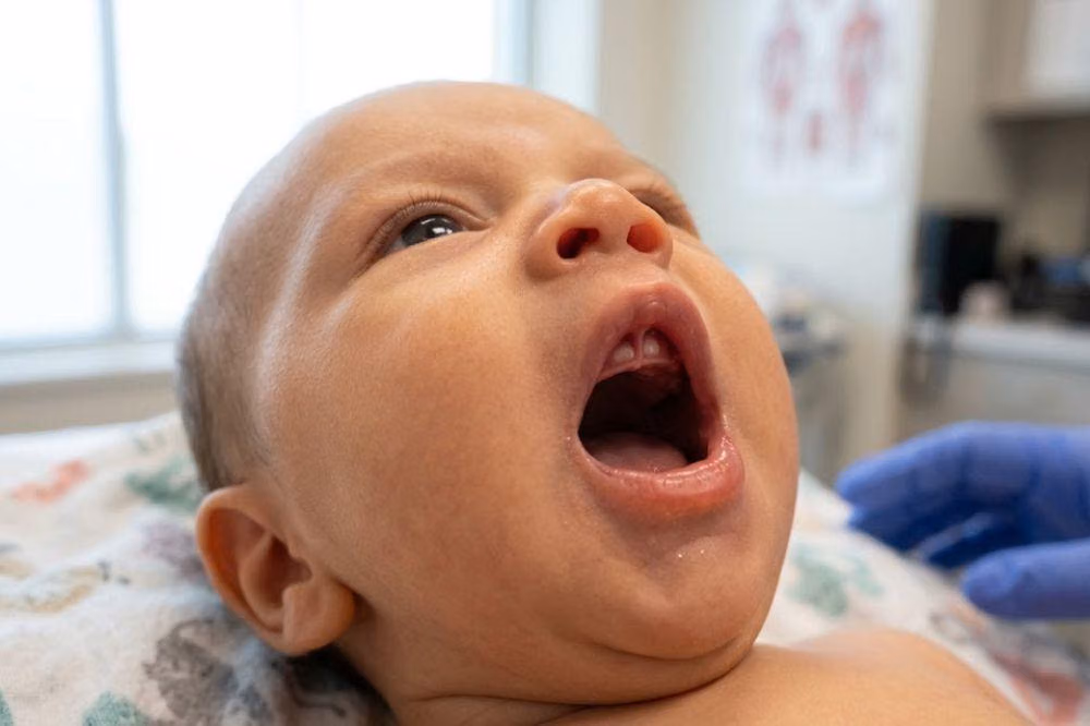 Lip Tie pada Bayi: Mengenali dan Menentukan Langkah