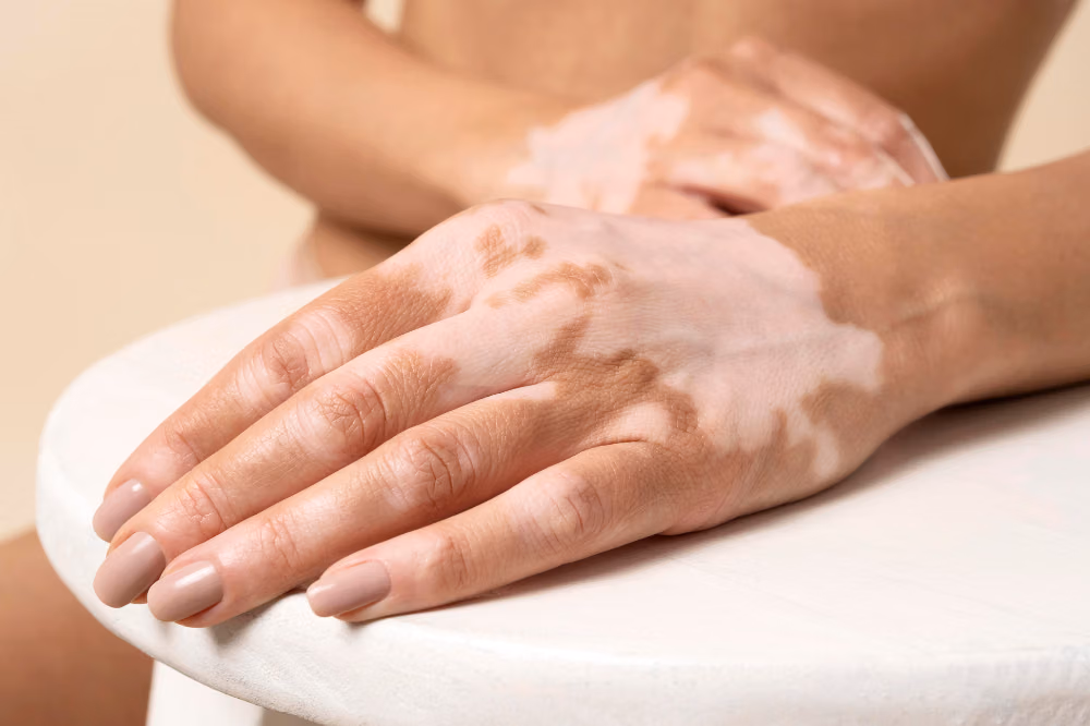 Gejala Awal Penyakit Autoimun Kulit yang Sering Dikira Dermatitis