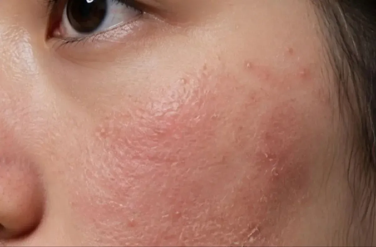 Memutus Siklus Gatal Eksim dengan Menguatkan Skin Barrier