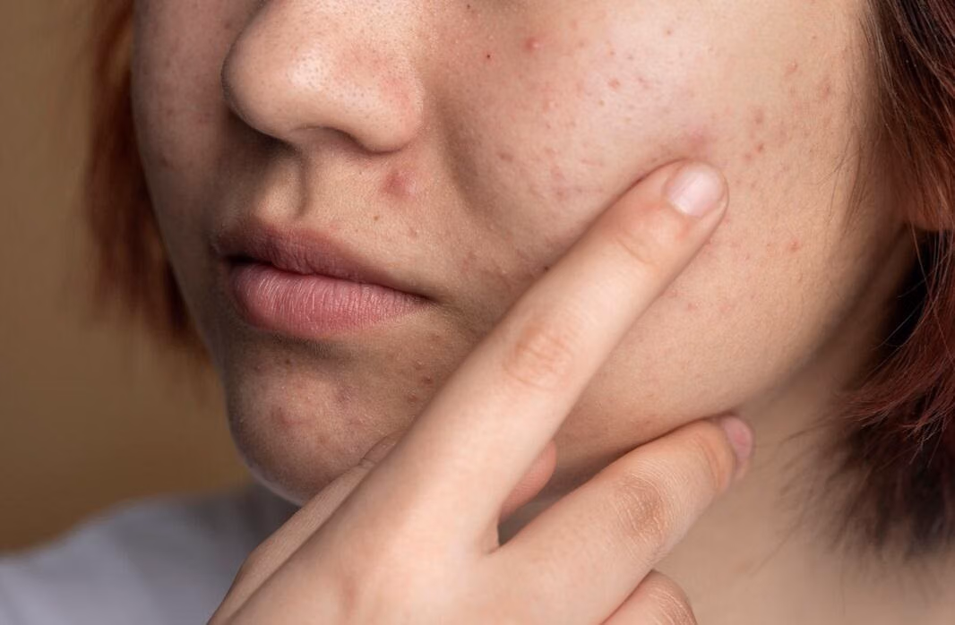 Jerawat saat Hamil: Memahami Hormon dan Skincare Aman