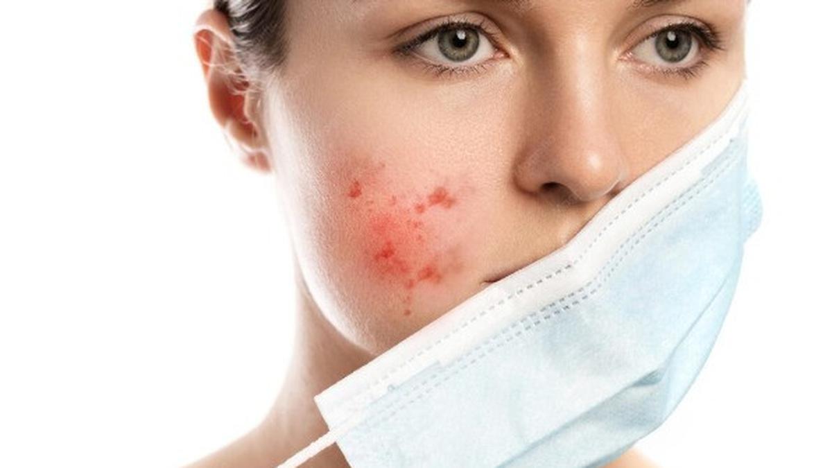 8 Kebiasaan Sehari-hari yang Diam-diam Memperburuk Jerawat