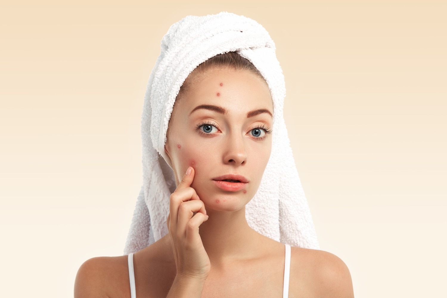 Panduan Lengkap Treatment Bekas Jerawat yang Terbukti Efektif