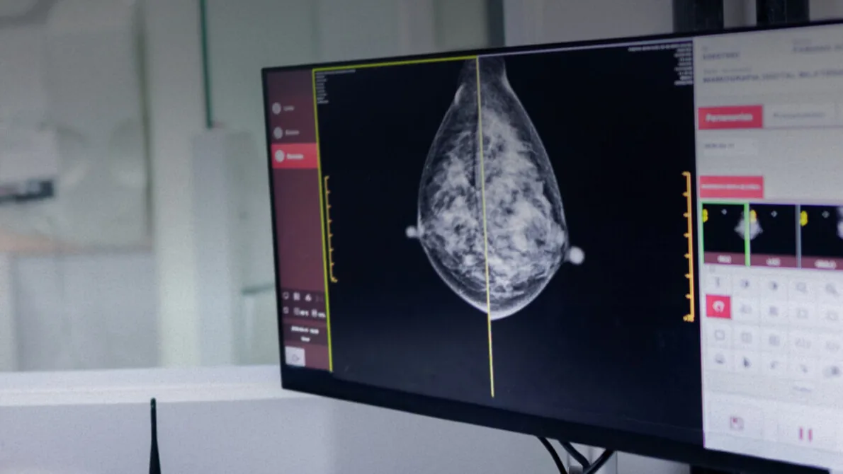 AI Deep Learning Dongkrak Deteksi Dini Kanker Paru Lewat CT Scan