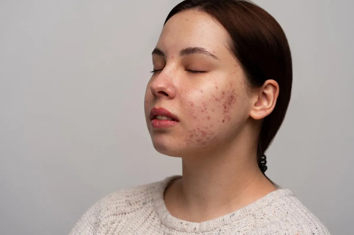5 Langkah Praktis Memulihkan Skin Barrier yang Rusak
