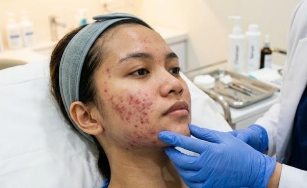 Mengapa Jerawat Terus Muncul Meski Sudah Skincare-an