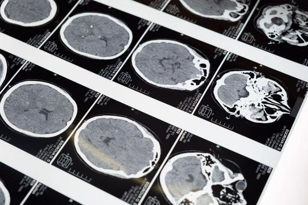 Tes Darah pTau 181 Plasma: Lompatan Baru Deteksi Dini Gangguan Neurologis