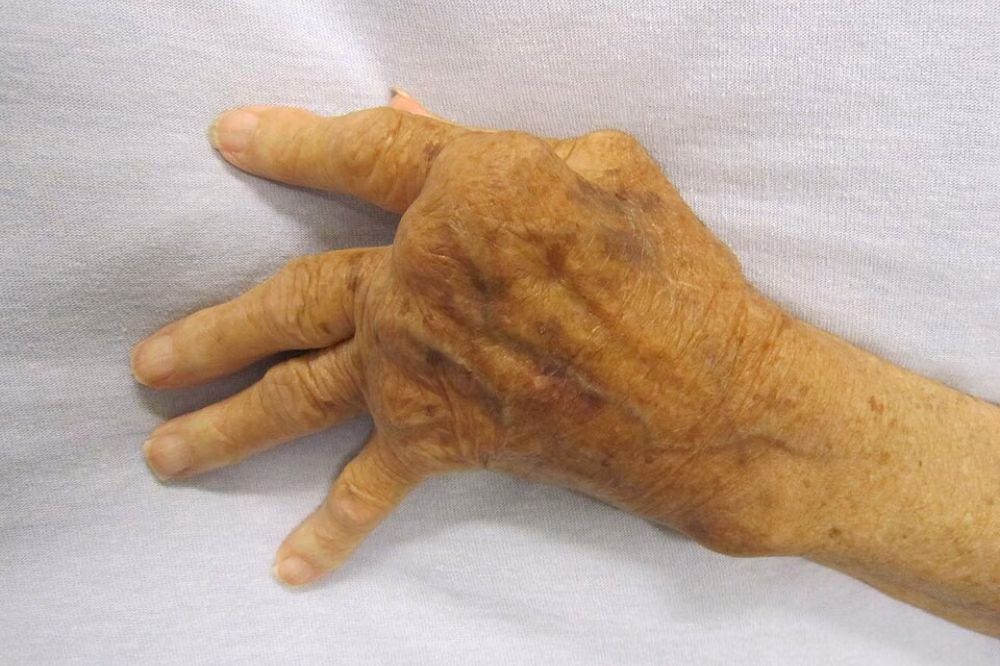 Mengapa Diagnosis Rheumatoid Arthritis Sering Memakan Waktu Lama