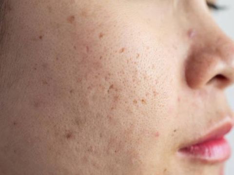 Bekas Jerawat Membandel: Laser atau Bedah Plastik?