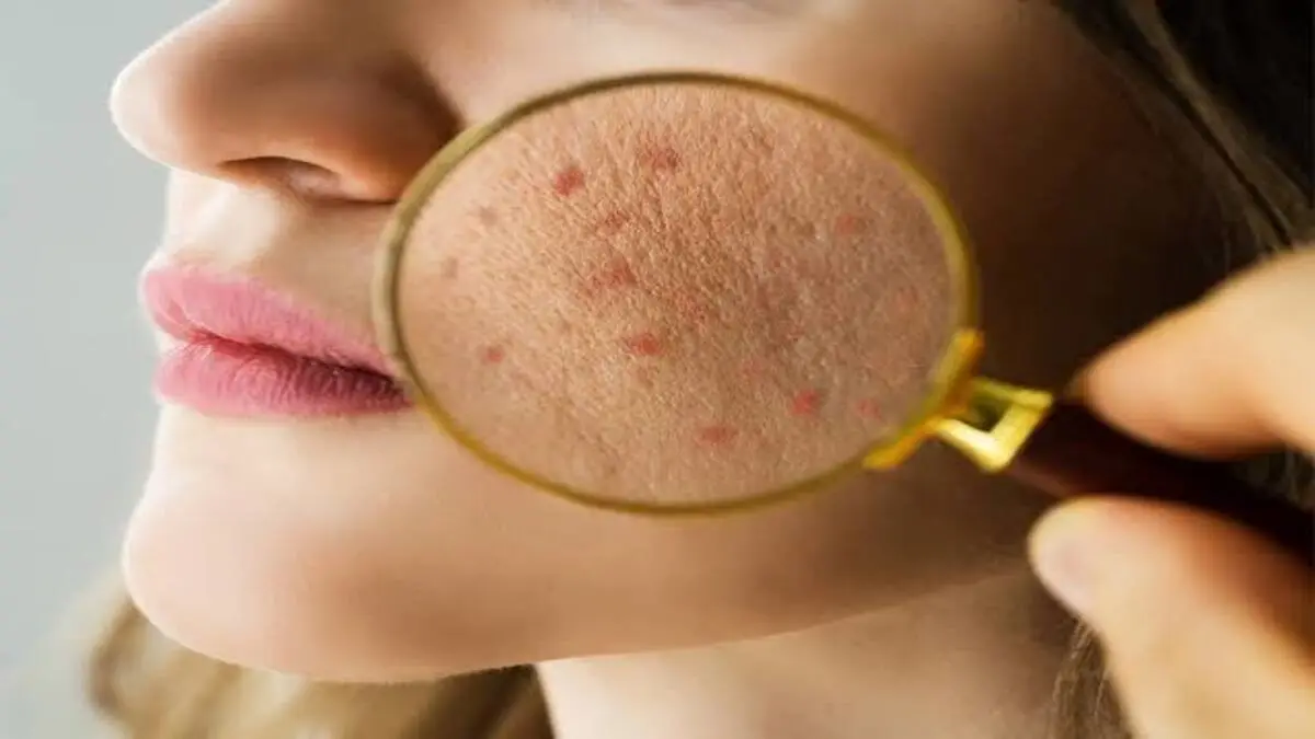 Polusi dan Sinar UV Merusak Skin Barrier: Strategi Dermatolog