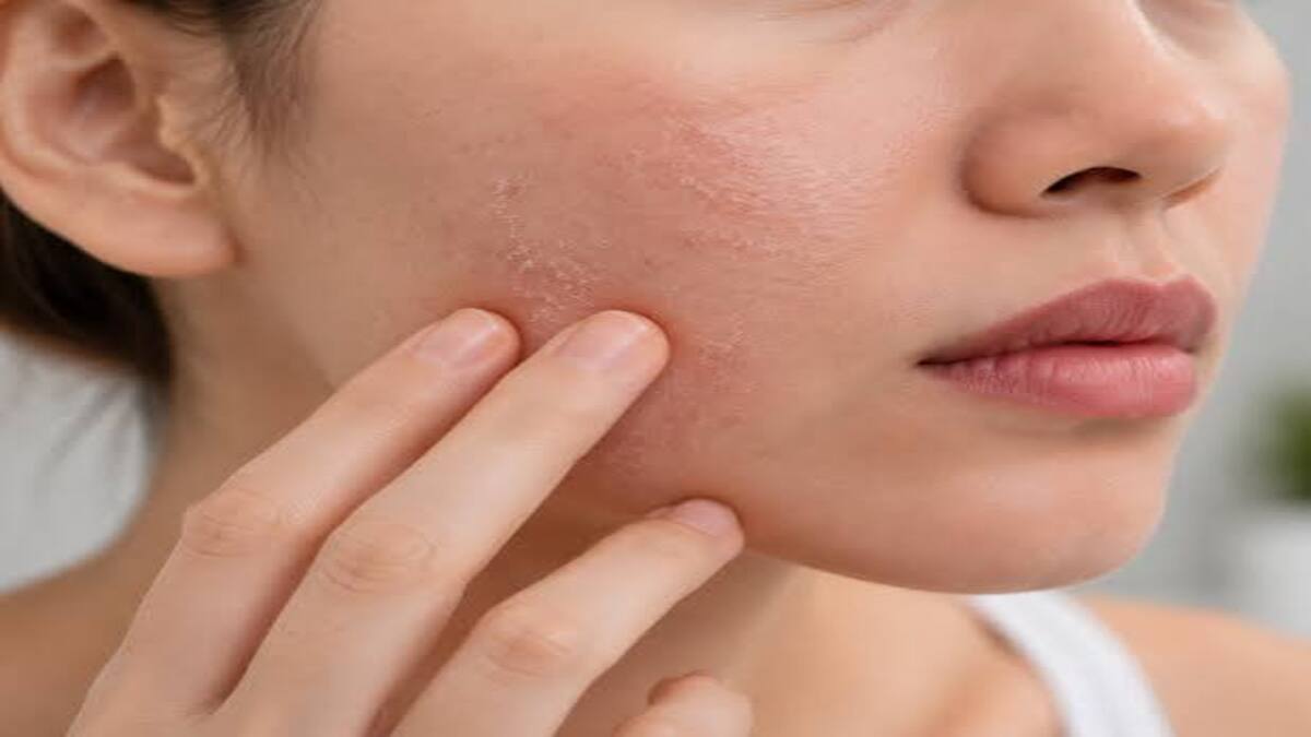 Menjaga Skin Barrier Saat Merawat Kulit Berjerawat