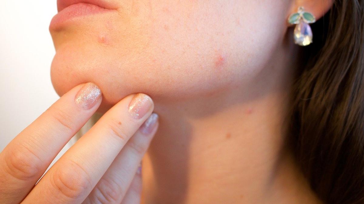 Jerawat Hormonal di Rahang: Penyebab, Perawatan, dan Pencegahan Kambuh