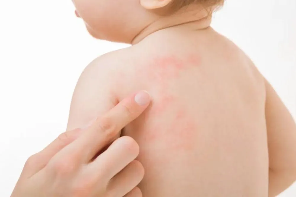 Mitos Pantang Makanan pada Anak Dermatitis Atopik