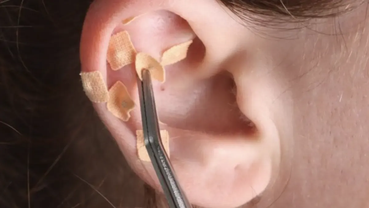 Ear Seeds untuk Meredakan Stres: Apa Kata Dokter Jiwa?