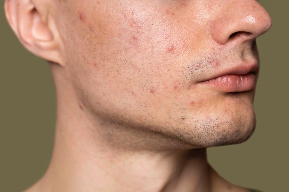 5 Serum Anti-Breakout Paling Lembut untuk Kulit Sensitif