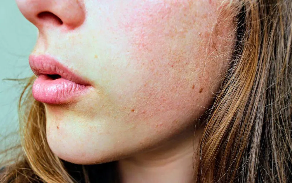 Memulihkan Skin Barrier Rusak pada Kulit Sensitif dan Eksim