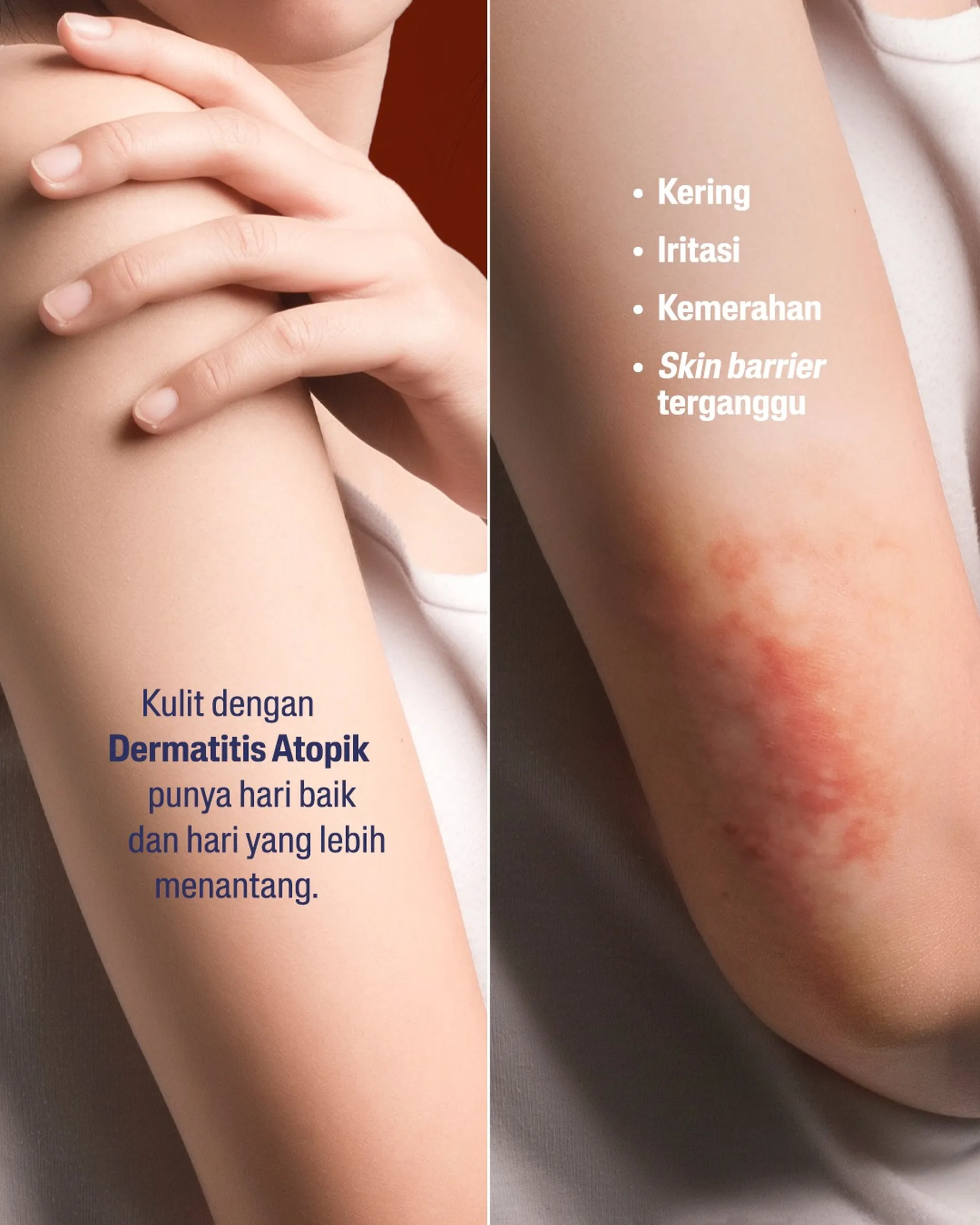 Memilih Pelembap yang Tepat untuk Kulit Eksim