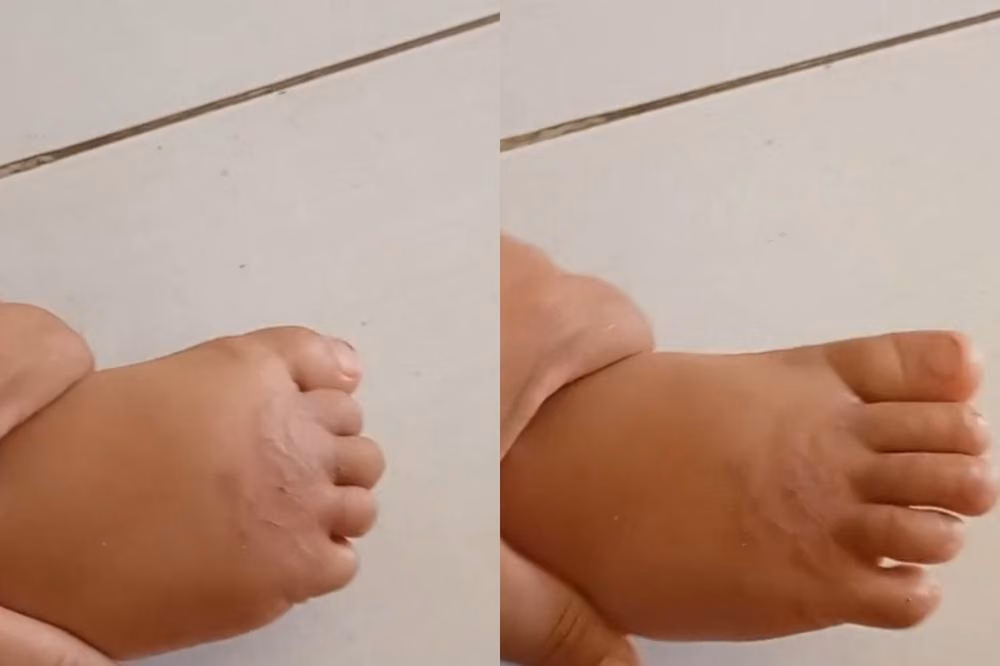 Bermain Tanpa Alas Kaki di Rumput dan Risiko Infeksi Cacing Tambang