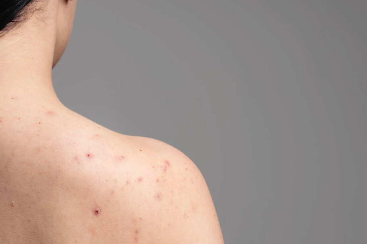 Purging atau Reaksi Buruk? Cara Membedakan Jerawat Setelah Ganti Skincare