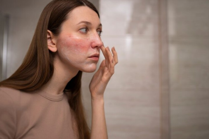 Purging atau Reaksi Buruk? Cara Membedakan Jerawat Setelah Ganti Skincare