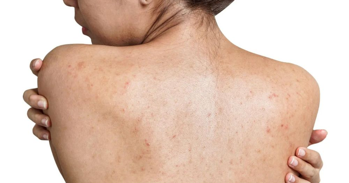 Body Wash Centella Asiatica Terbaik untuk Jerawat Punggung