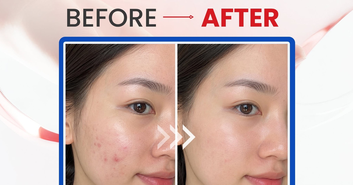 3 Produk Benzoyl Peroxide Drugstore Terbaik untuk Jerawat Meradang