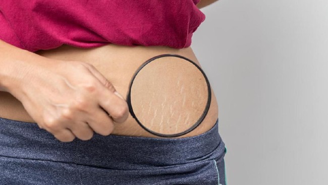 Stretch Mark Bisa Hilang? Panduan Realistis dari Pencegahan hingga Treatment Medis