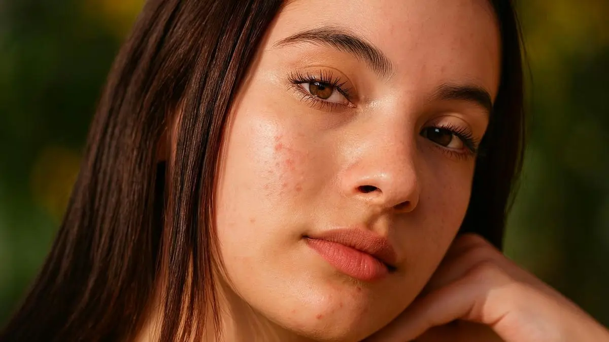 Gut-Skin Axis: Kunci Kesehatan Pencernaan untuk Kulit Sehat