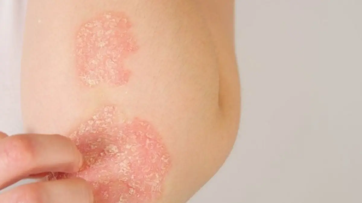 Strategi Dermatolog Mengelola Eksim dengan Skincare Tanpa Alkohol