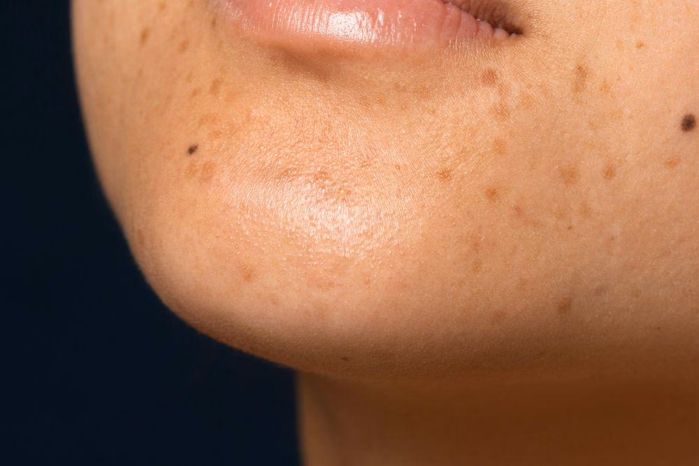Panduan Skincare Pencerah yang Aman Selama Kehamilan