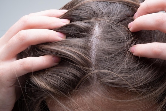 Jari-jari membuka belahan rambut memperlihatkan kulit kepala dari dekat