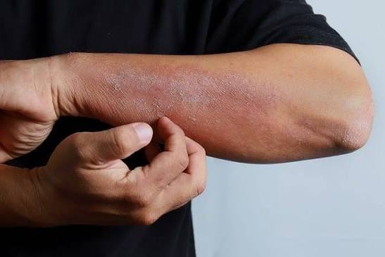 Kulit Kering saat Cuaca Panas? Cara Lengkap Menjaga Kelembapan