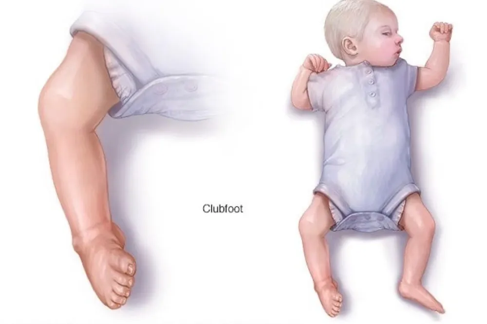 Clubfoot pada Bayi: Deteksi Dini dan Penanganan Optimal