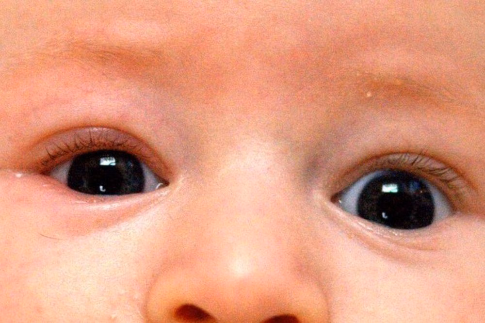 Blefaritis pada Bayi: Mengenali Infeksi Mata Ringan dan Tanda Bahaya